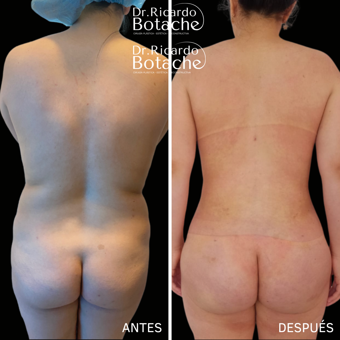Abdominal Contour