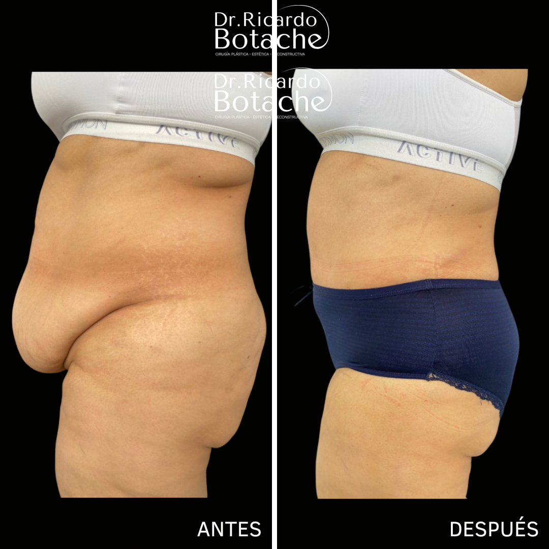 Abdominal Contour