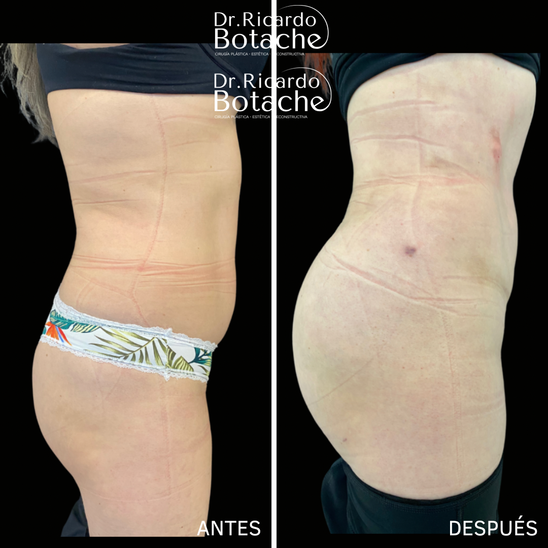 Buttock Augmentation