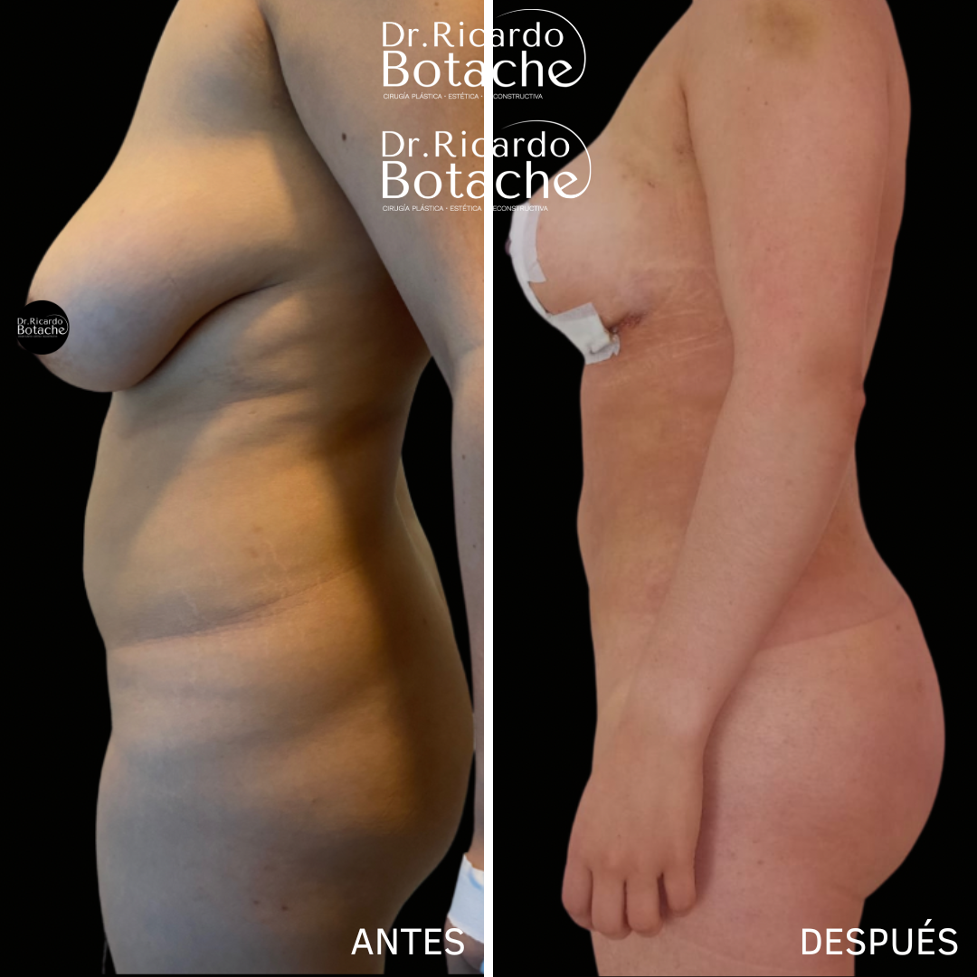 Breast Augmentation
