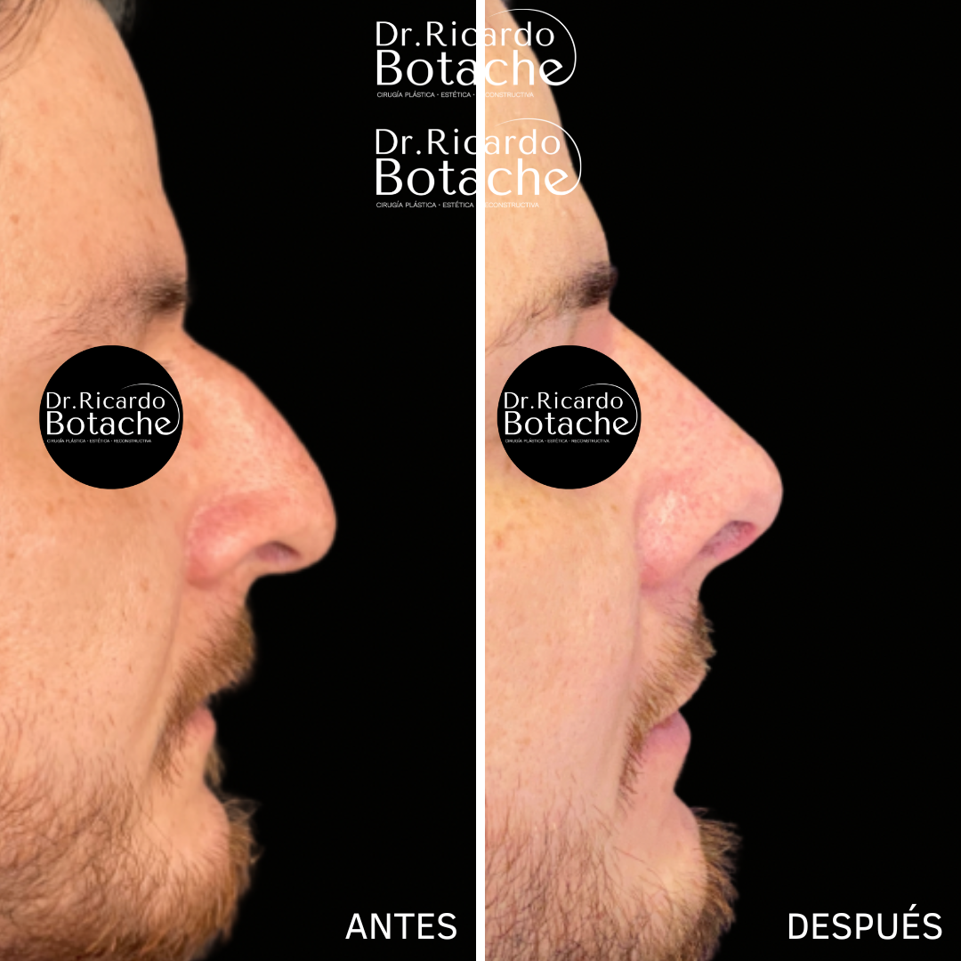 Rhinoplasty