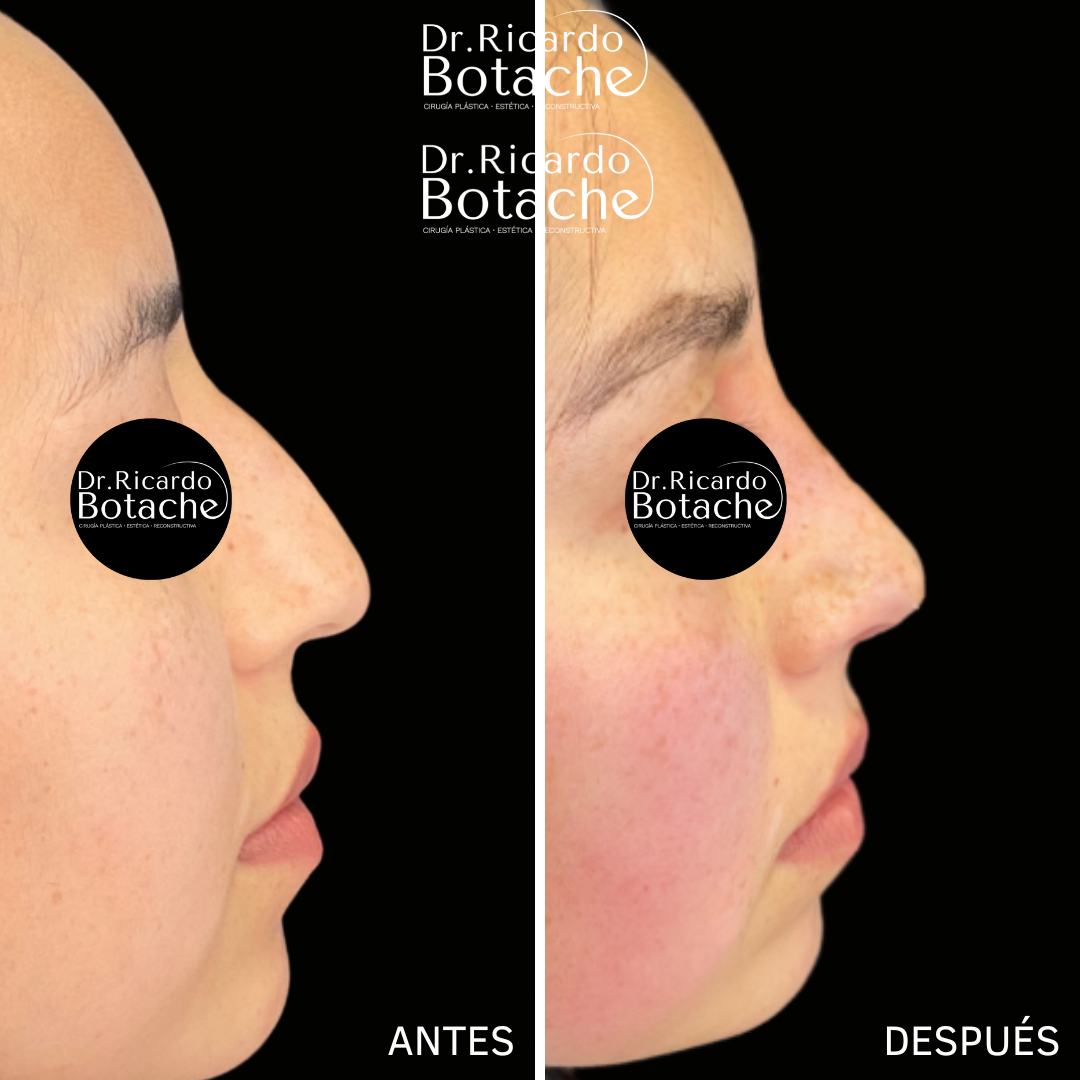 Rhinoplasty