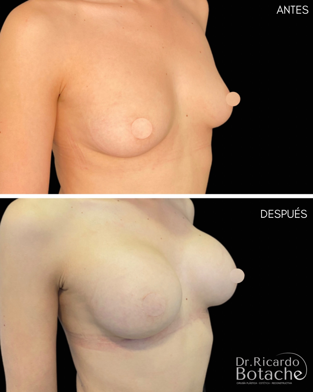 Breast Augmentation