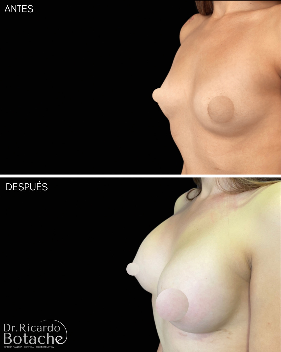 Breast Augmentation