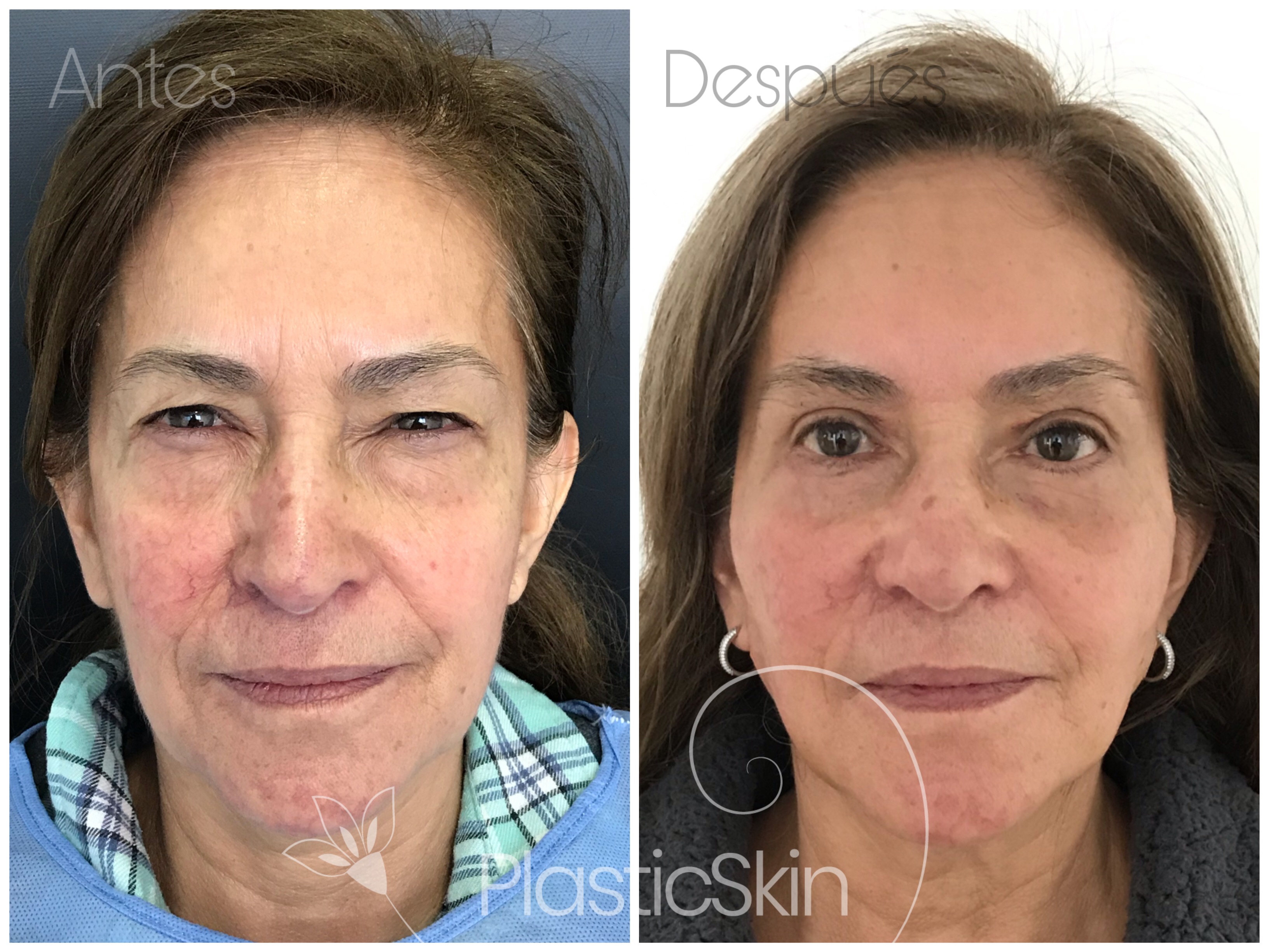 Blepharoplasty