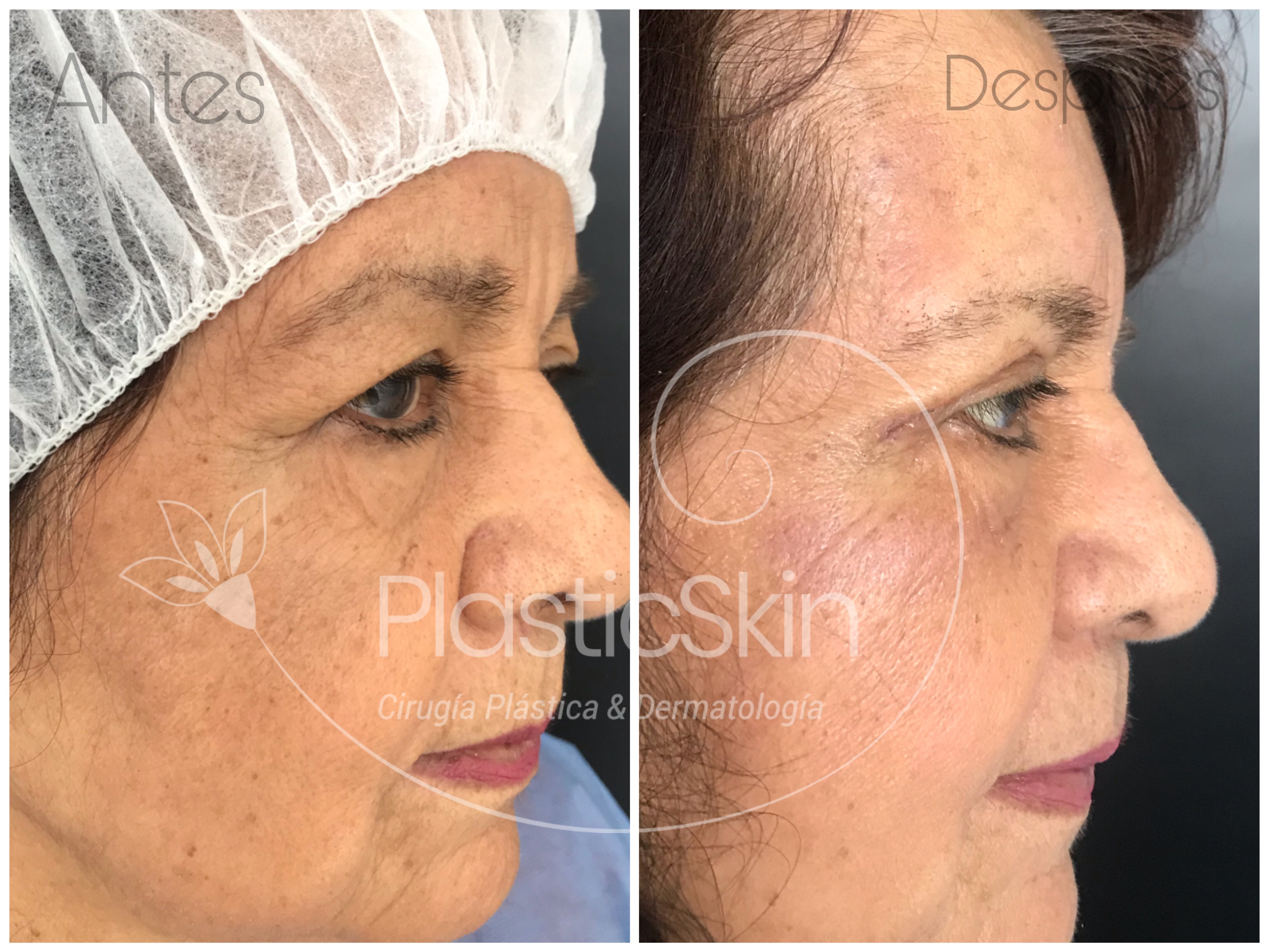 Blepharoplasty