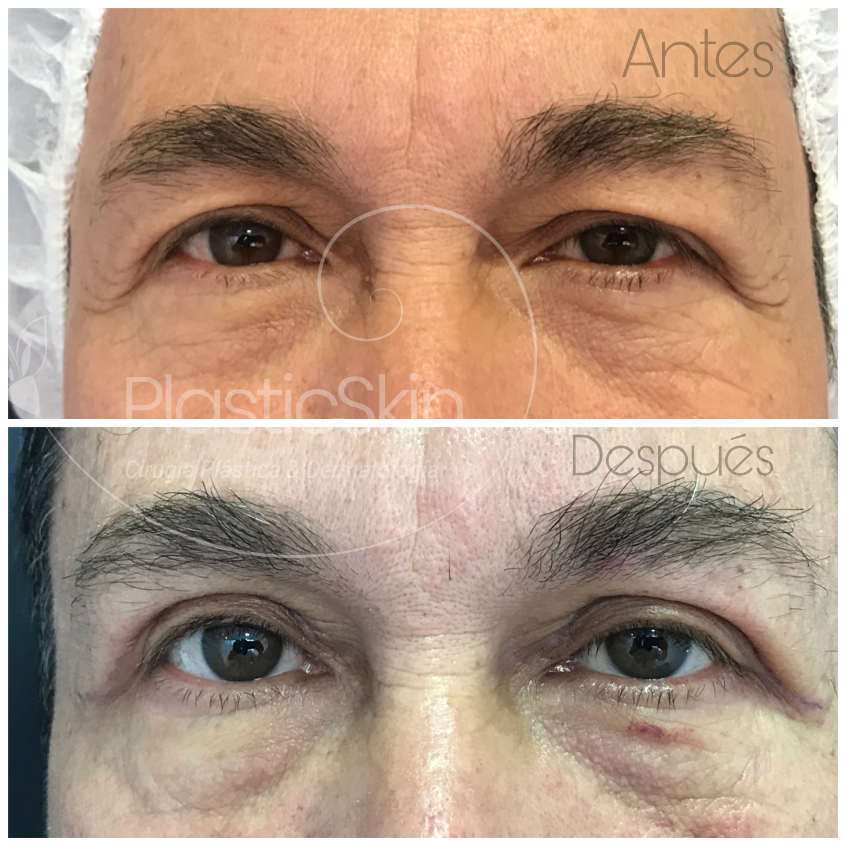 Blepharoplasty