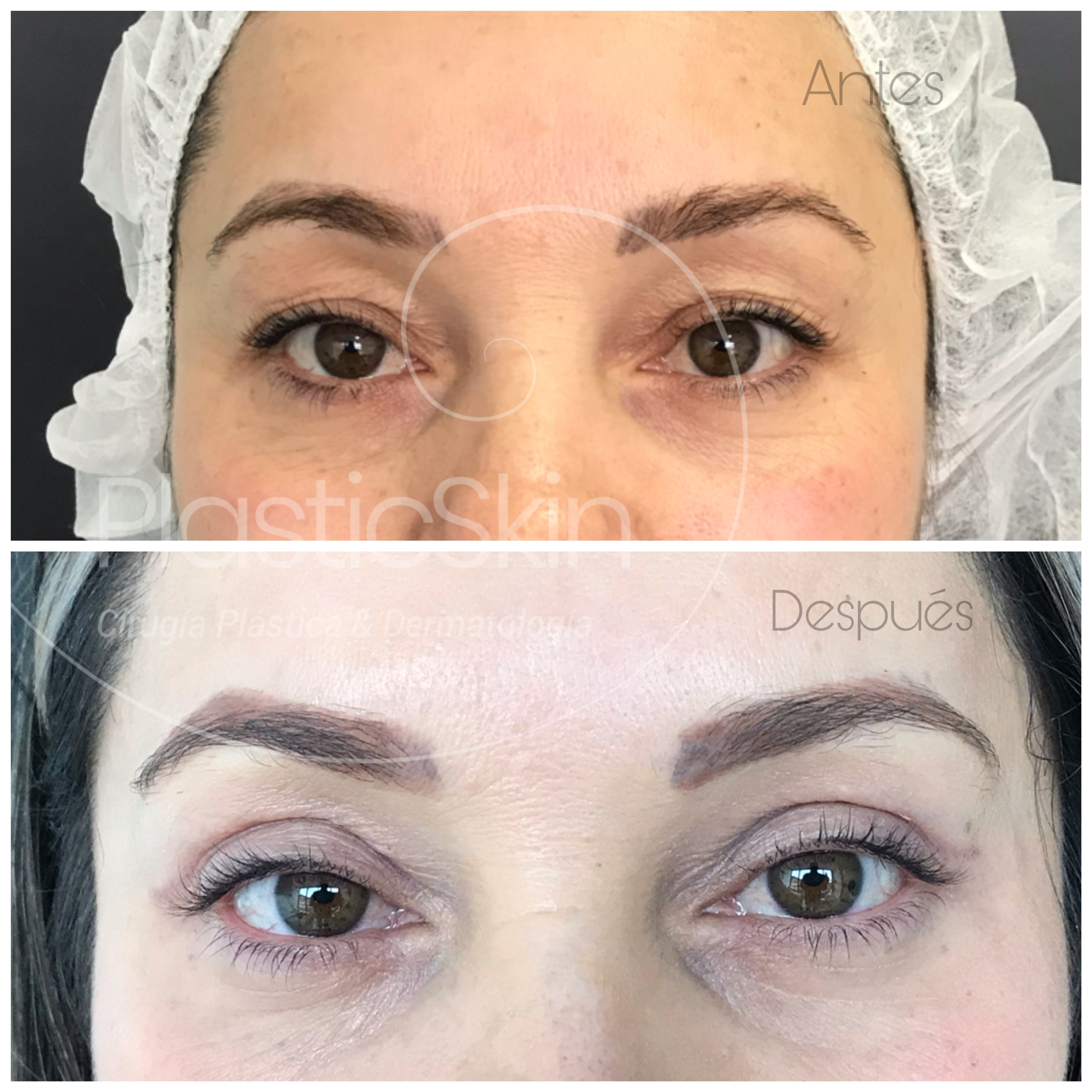 Blepharoplasty