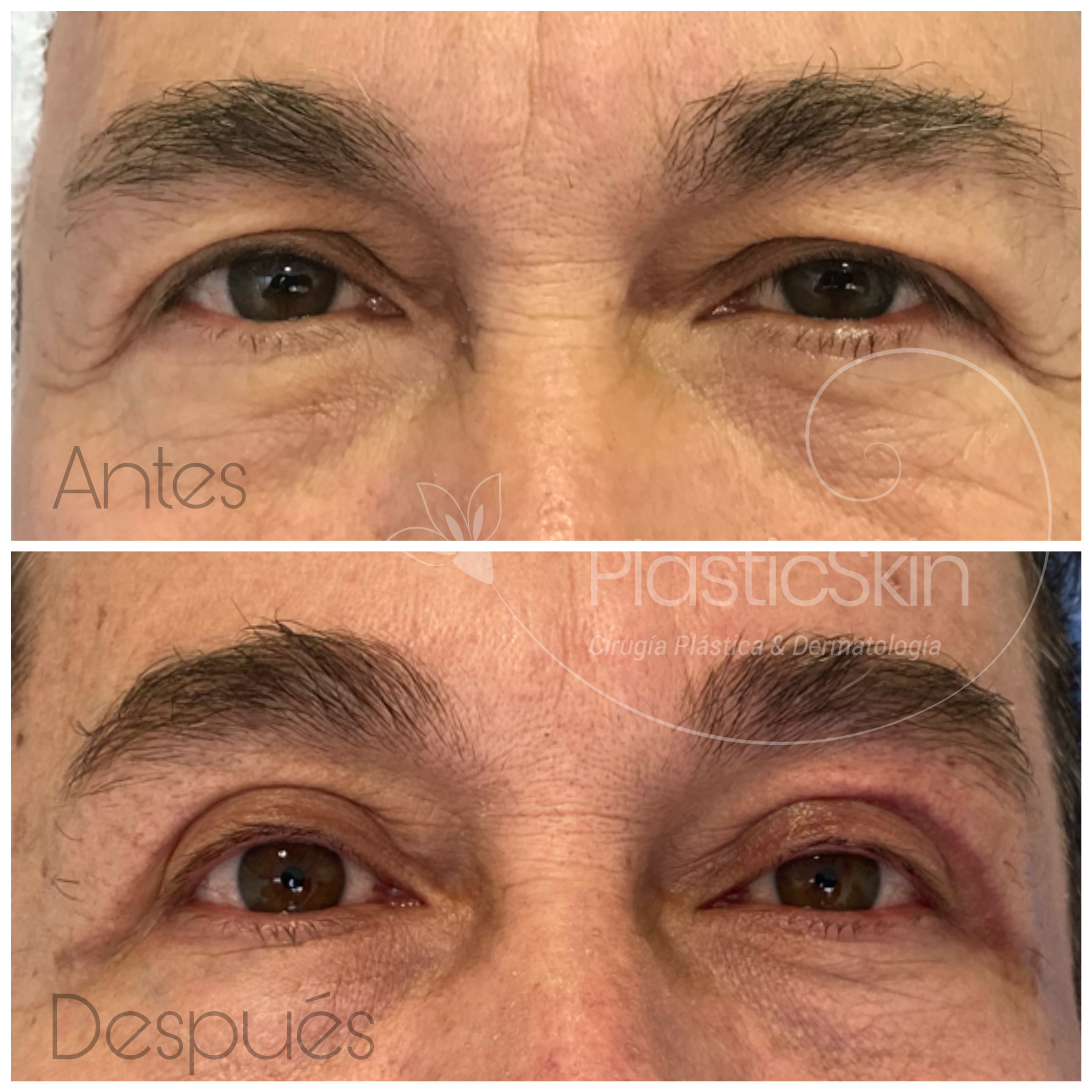 Blepharoplasty