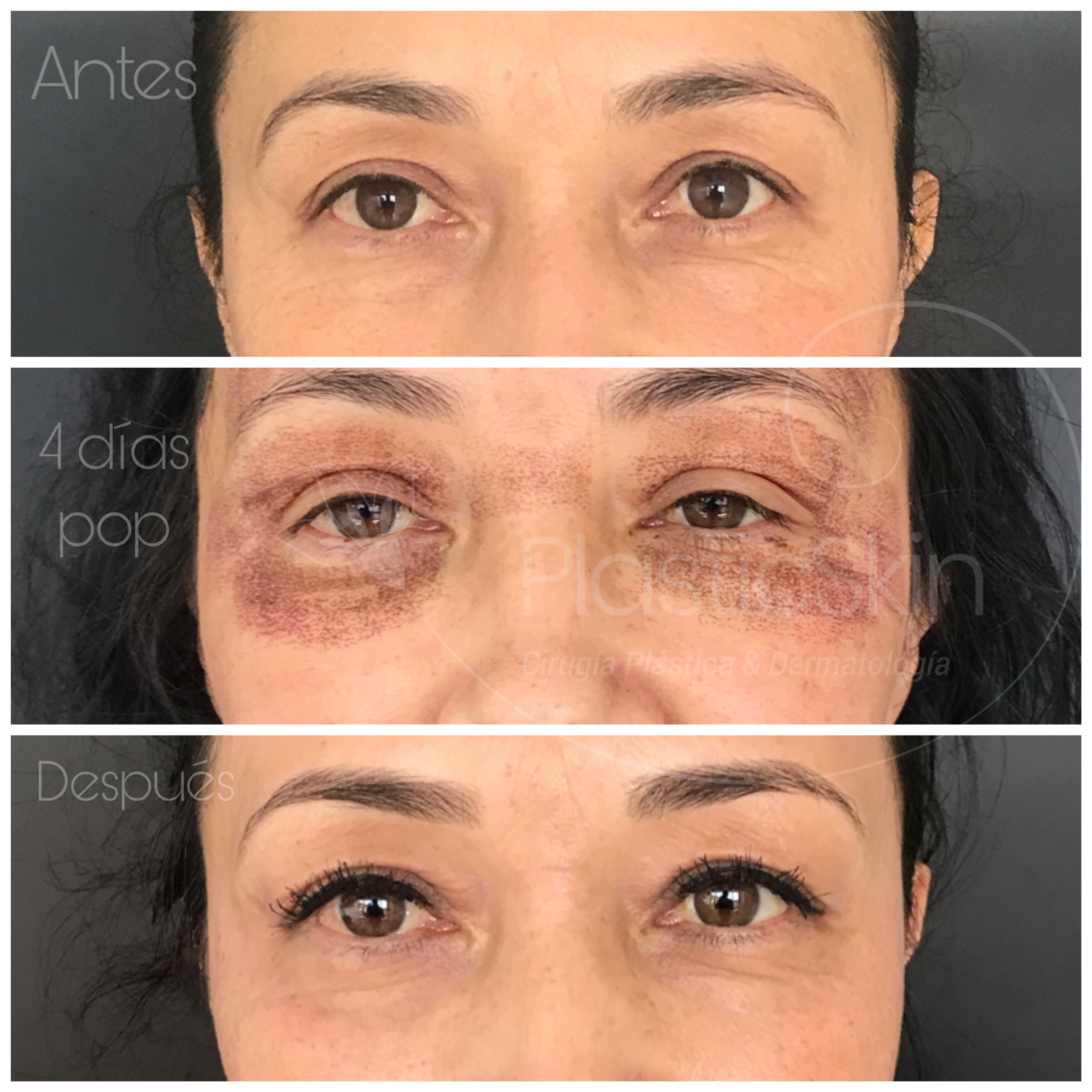 Blepharoplasty