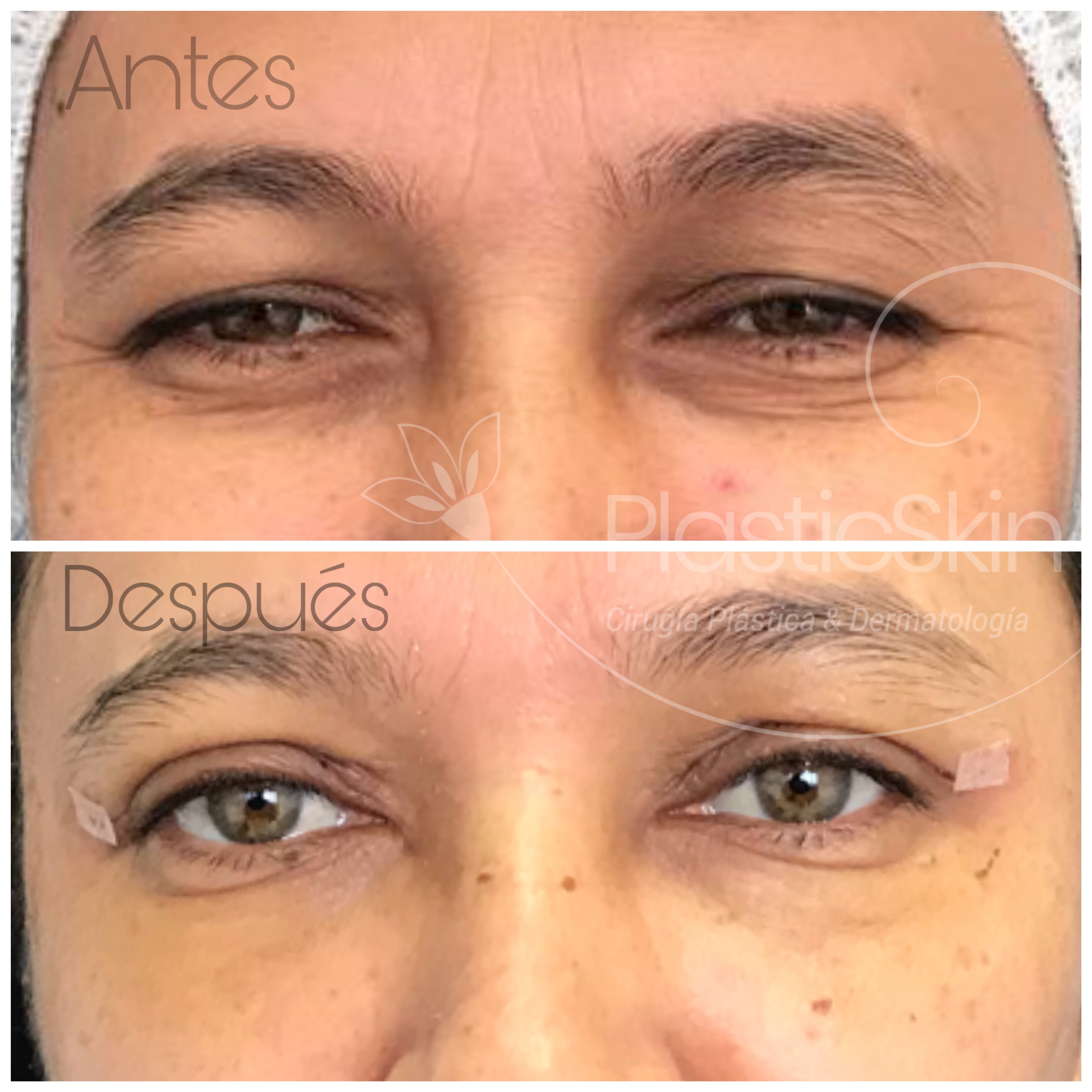 Blepharoplasty