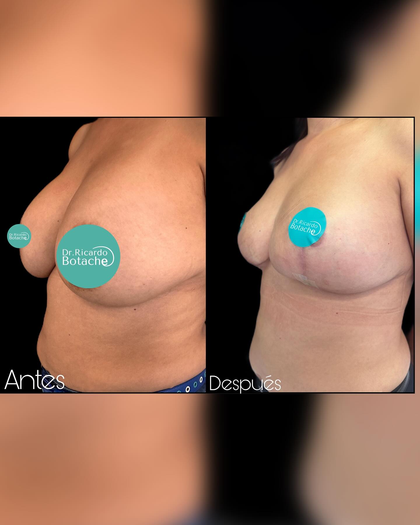 Breast Expansion