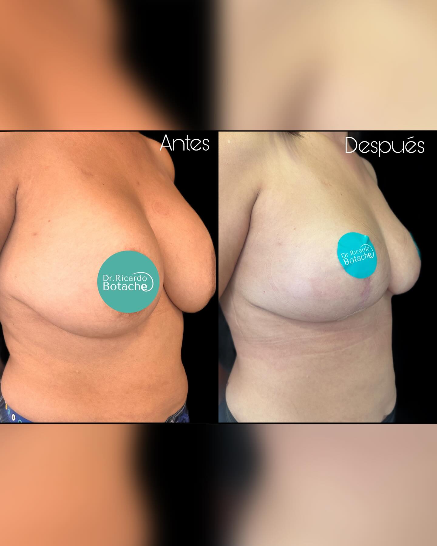 Breast Expansion