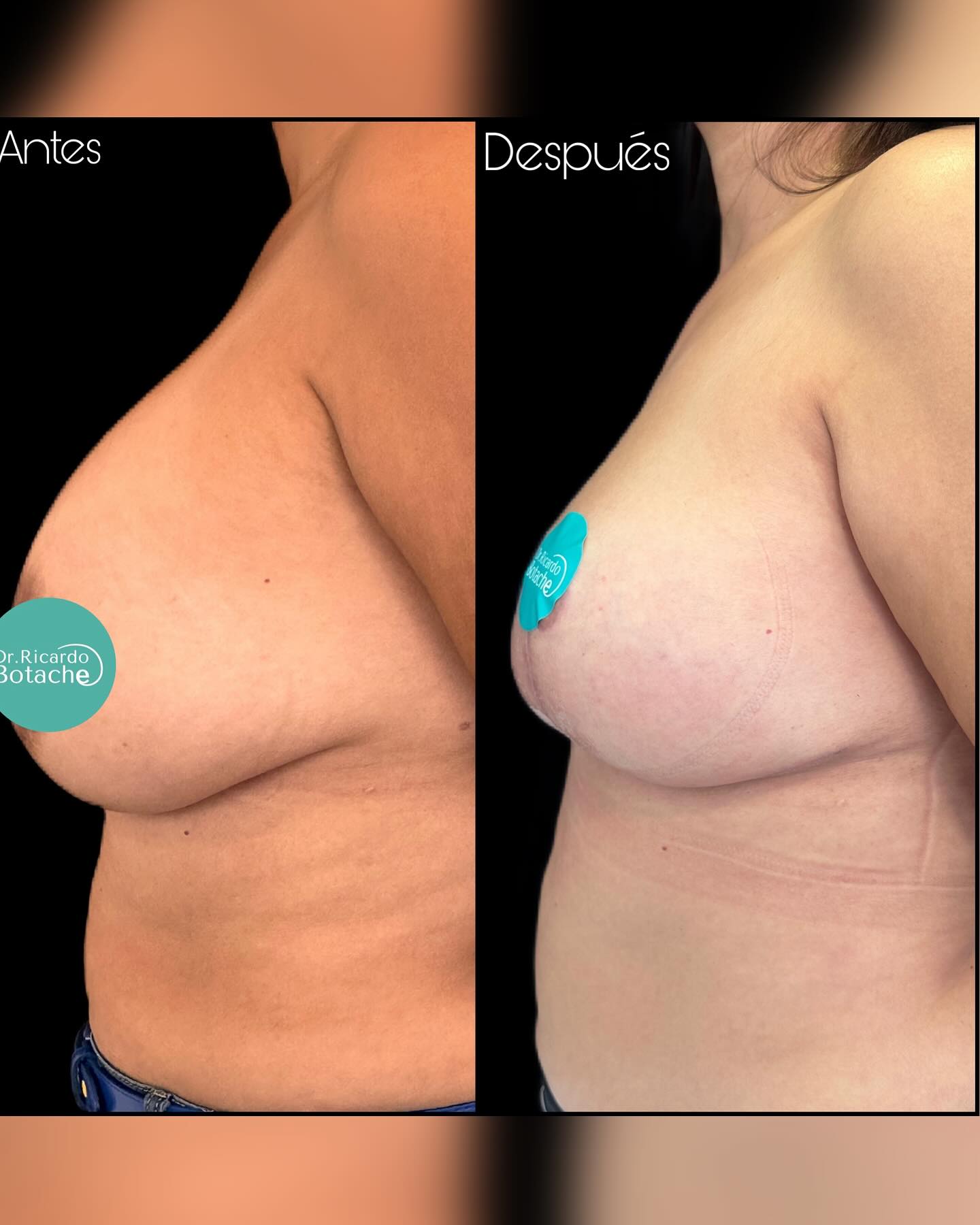 Breast Expansion