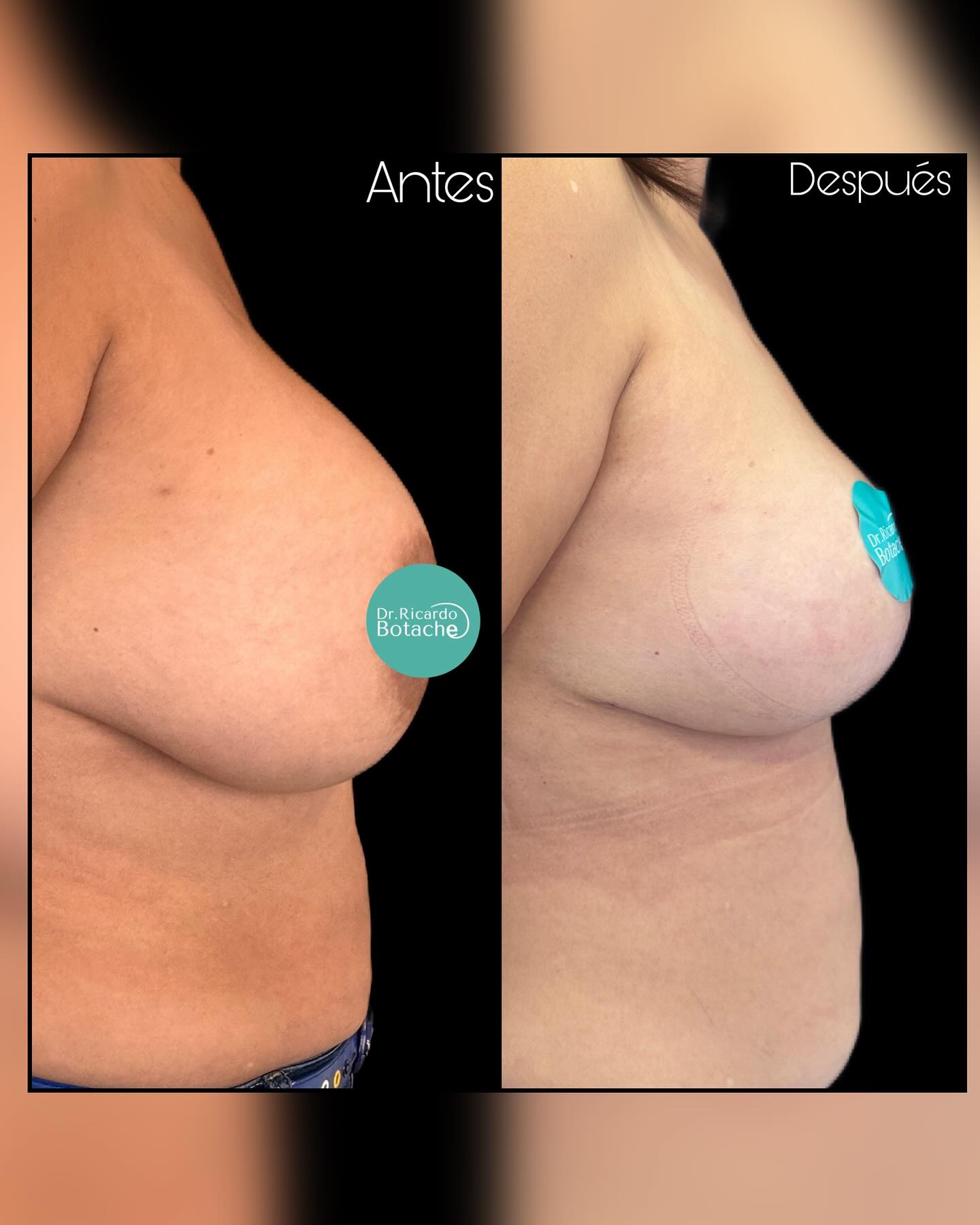 Breast Expansion