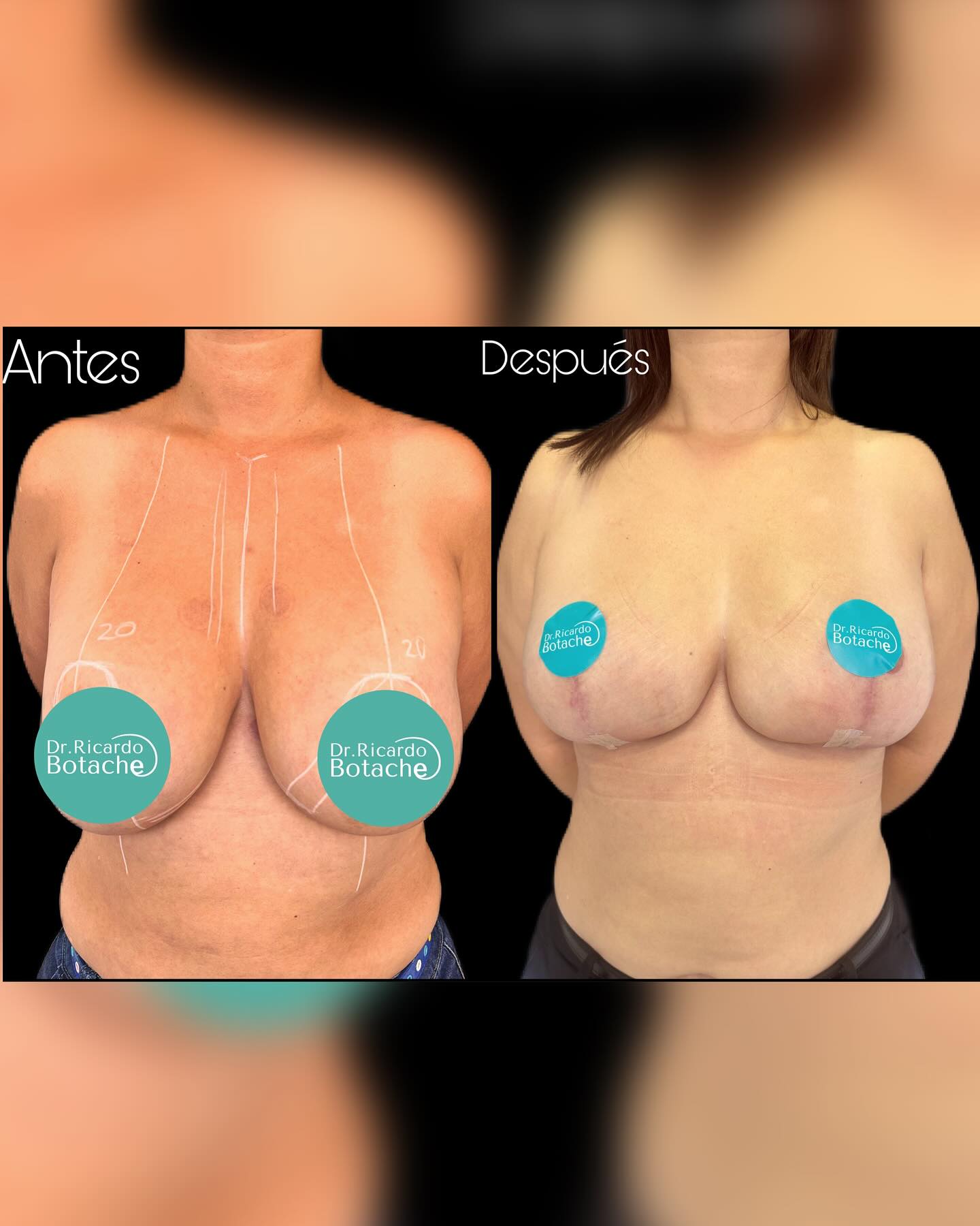 Breast Expansion