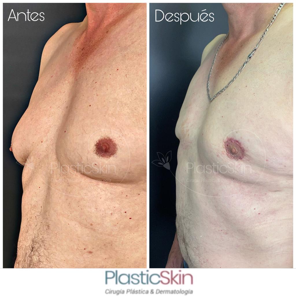 Gynecomastia