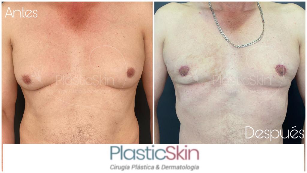 Gynecomastia