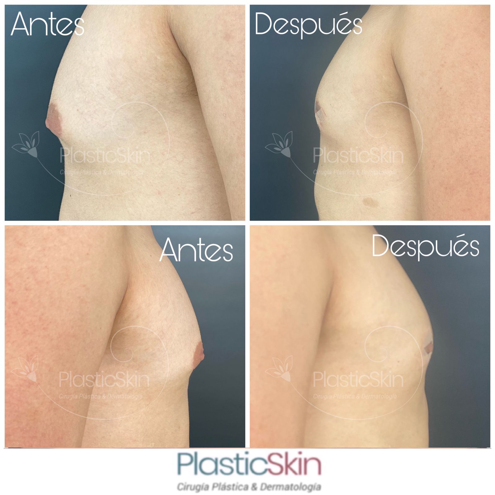 Gynecomastia