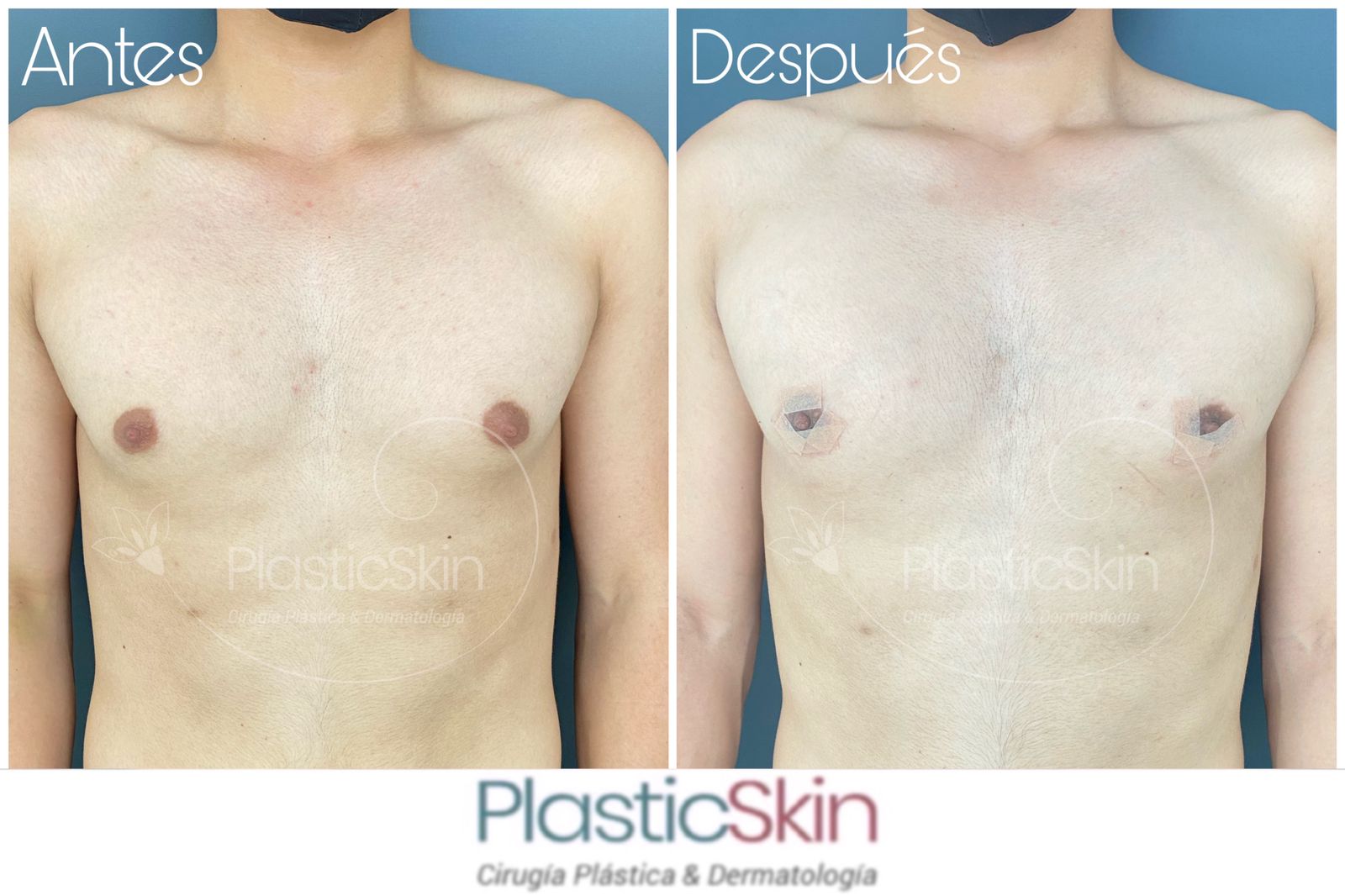 Gynecomastia