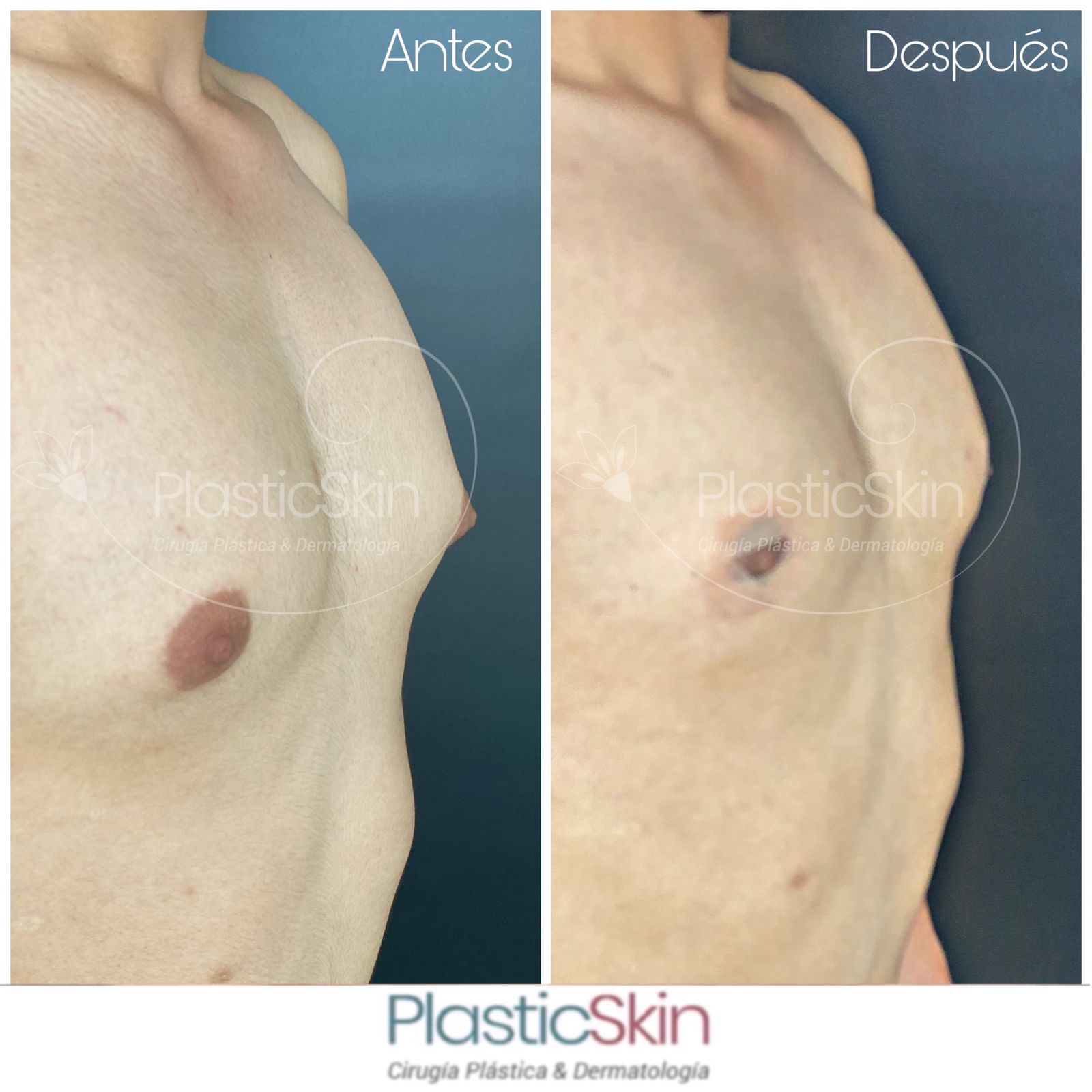 Gynecomastia