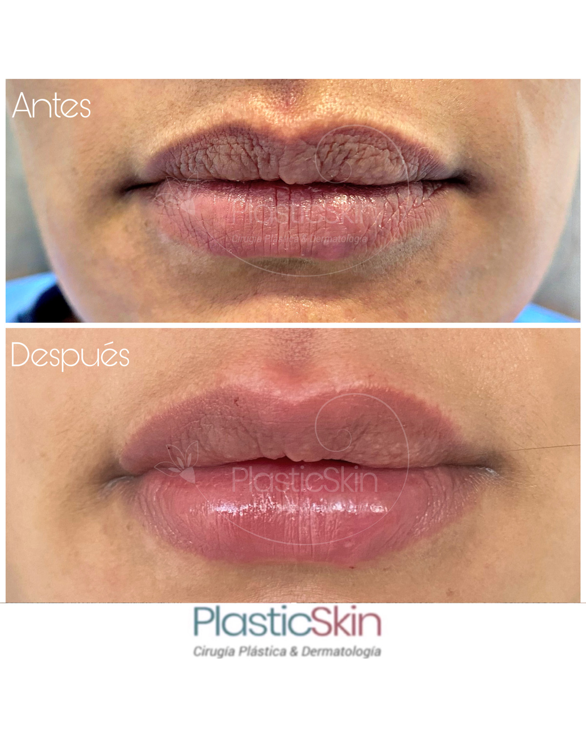 Lips