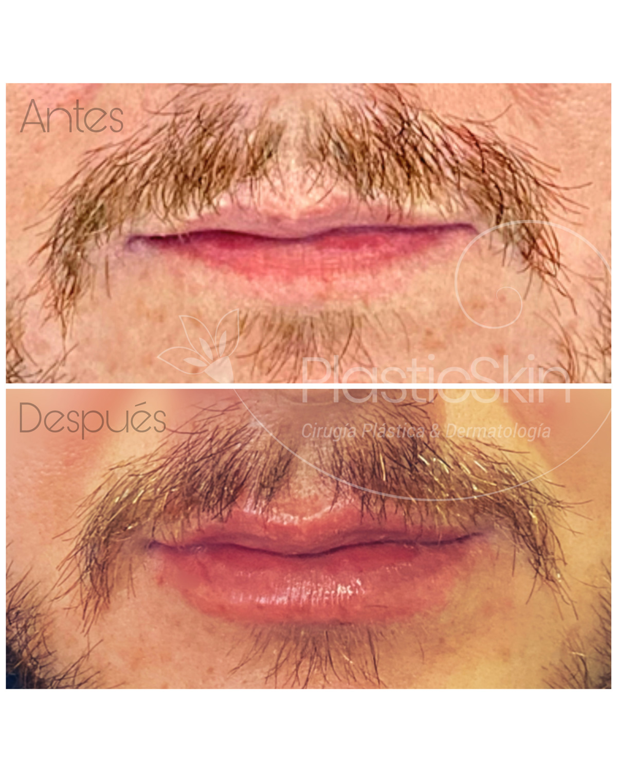 Lips