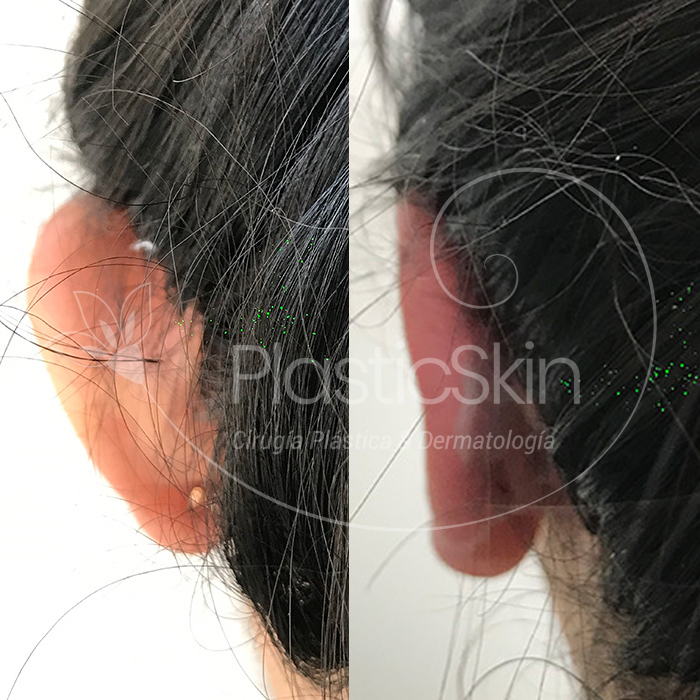 Otoplasty