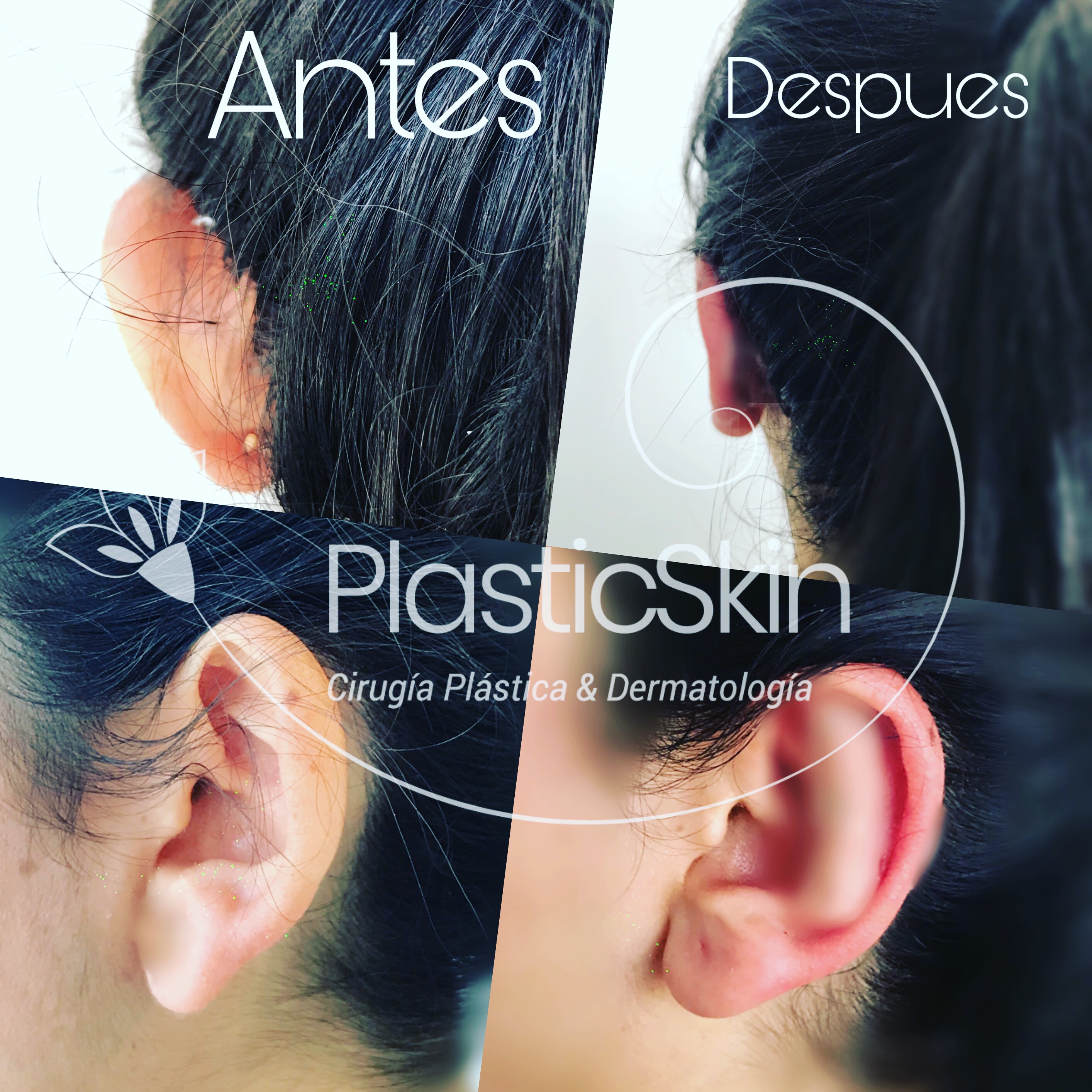Otoplasty