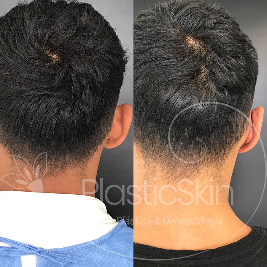 Otoplasty