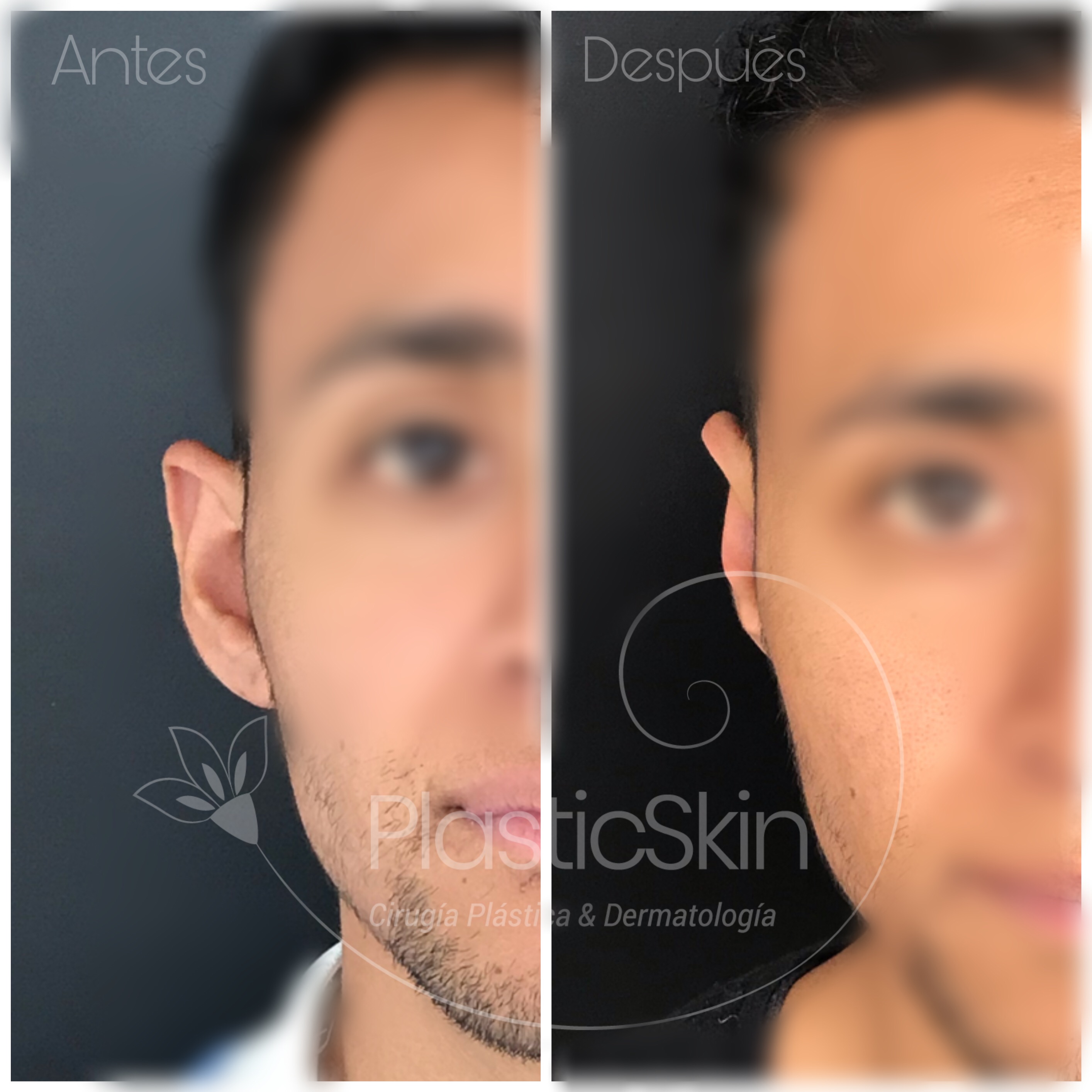 Otoplasty