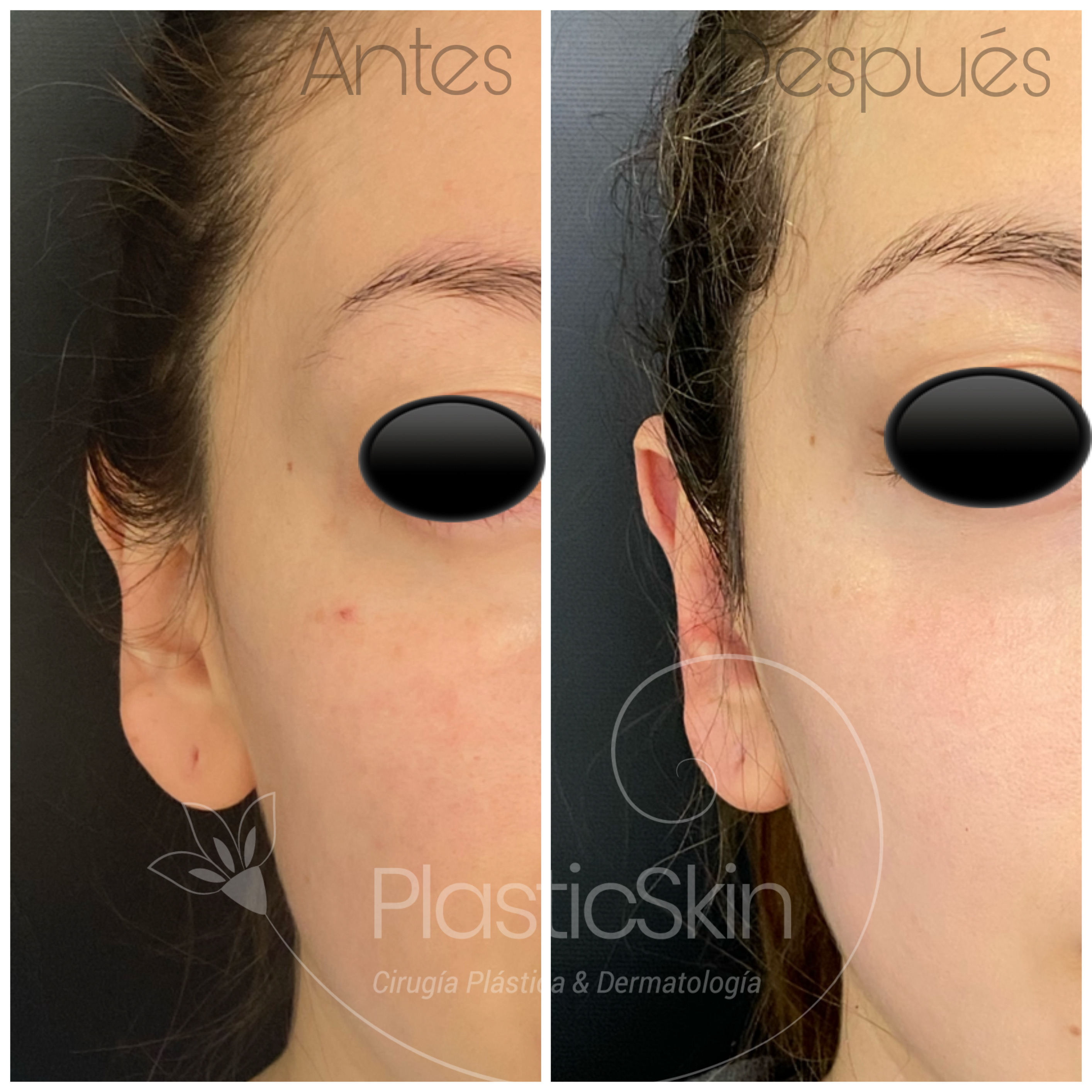 Otoplasty