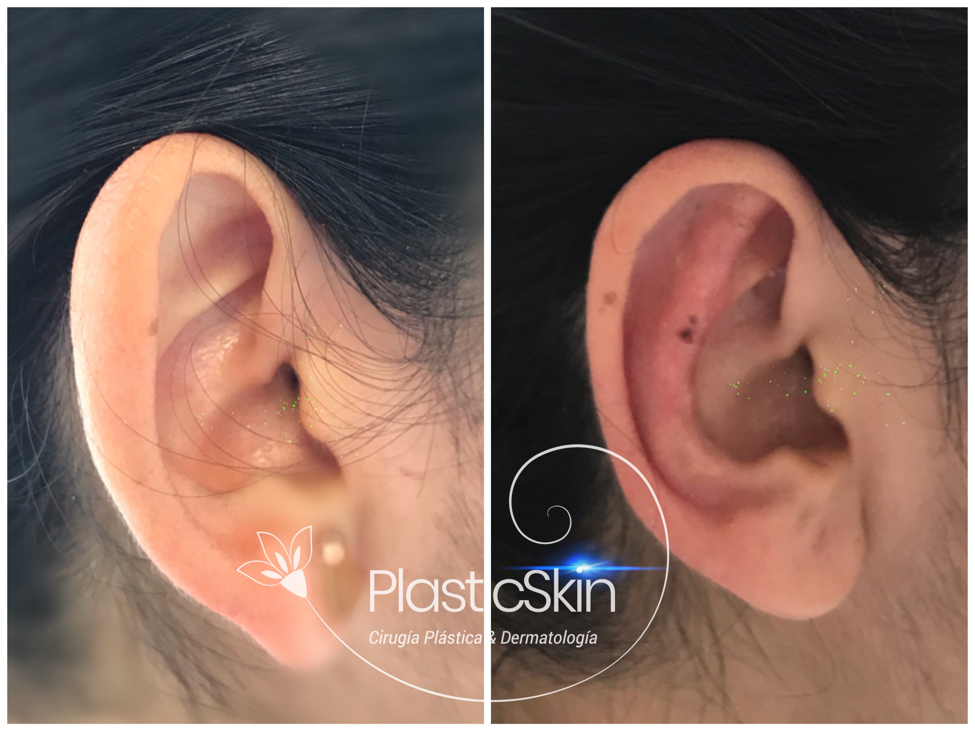 Otoplasty