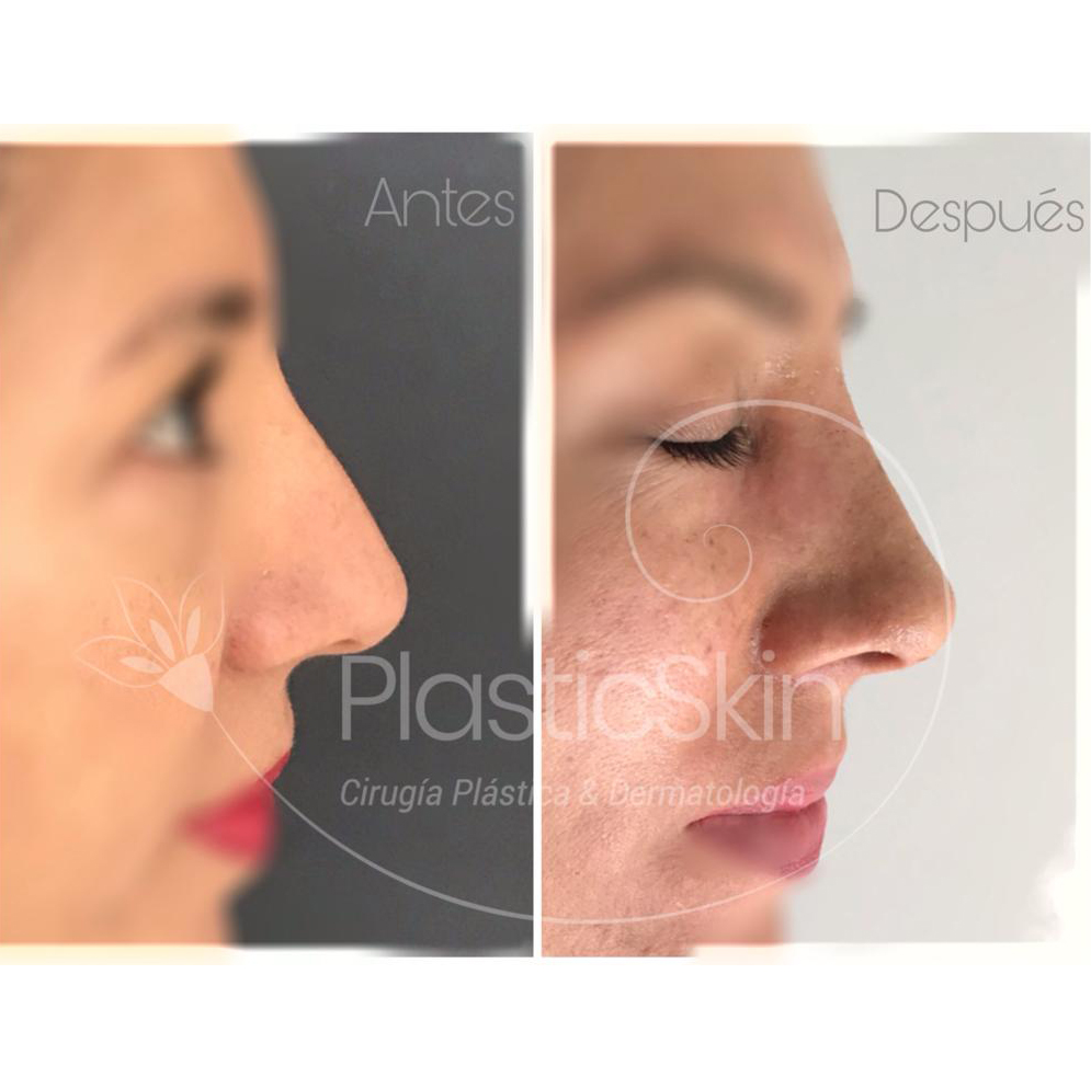 Rhinoplasty