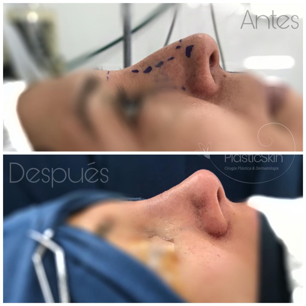 Rhinoplasty