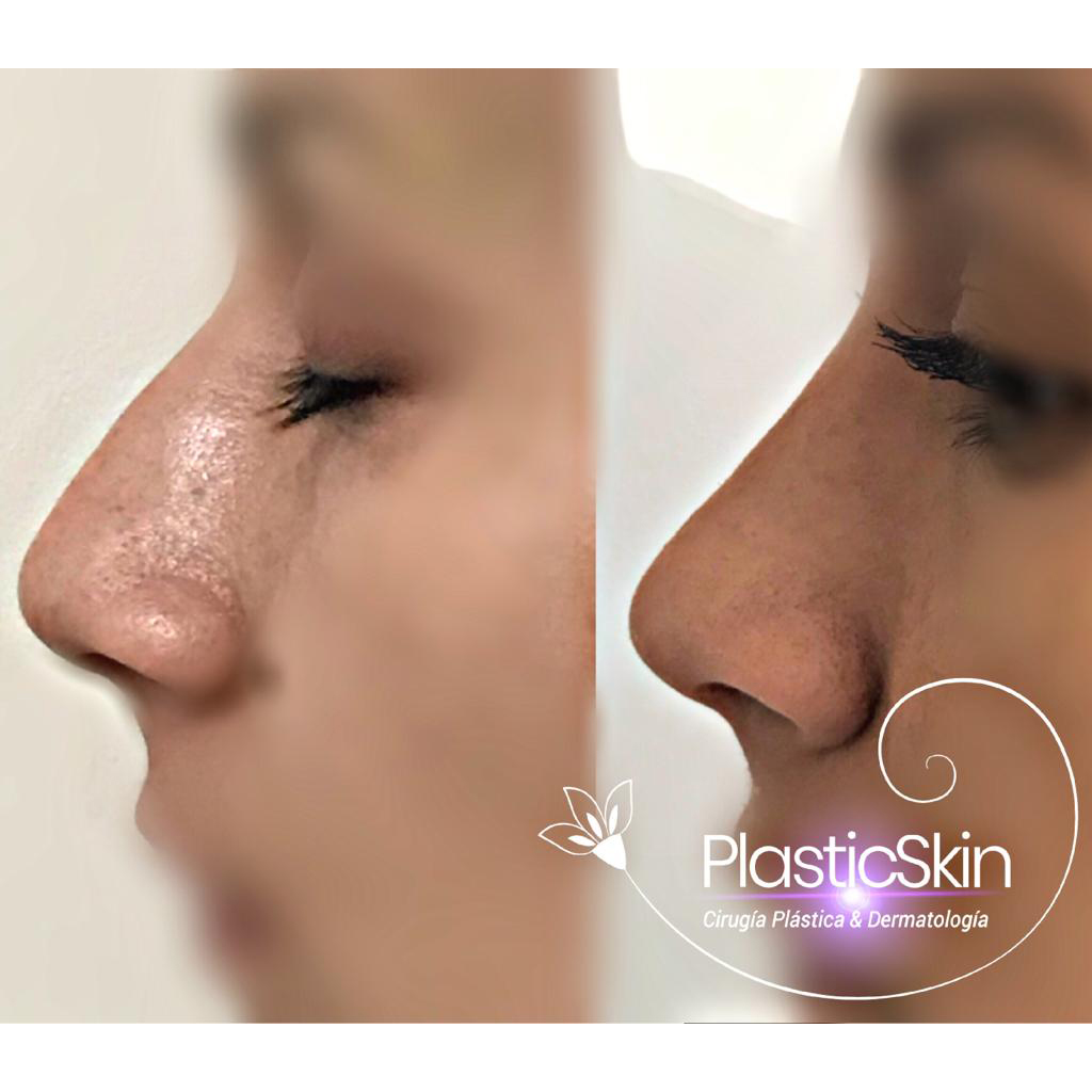 Rhinoplasty