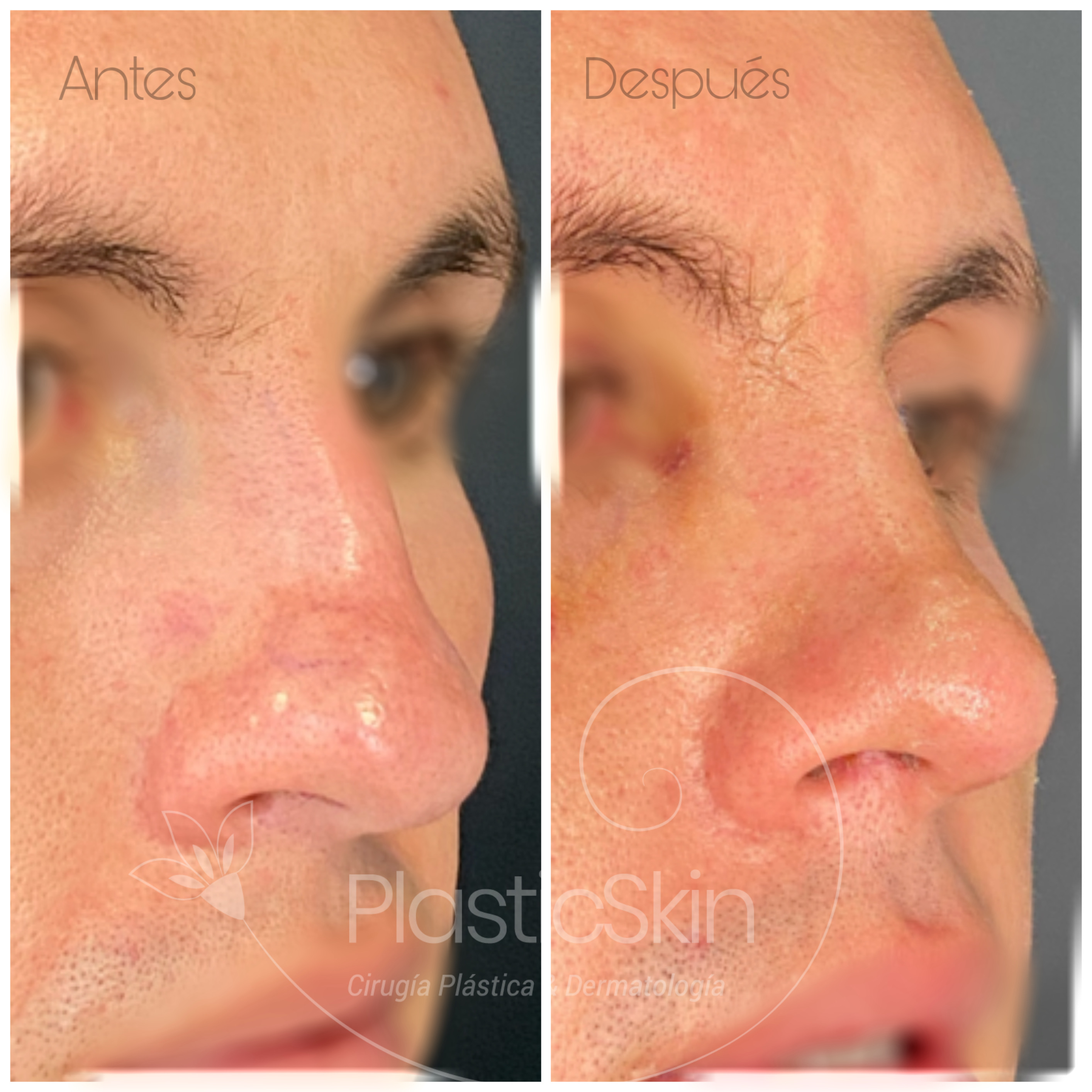Rhinoplasty