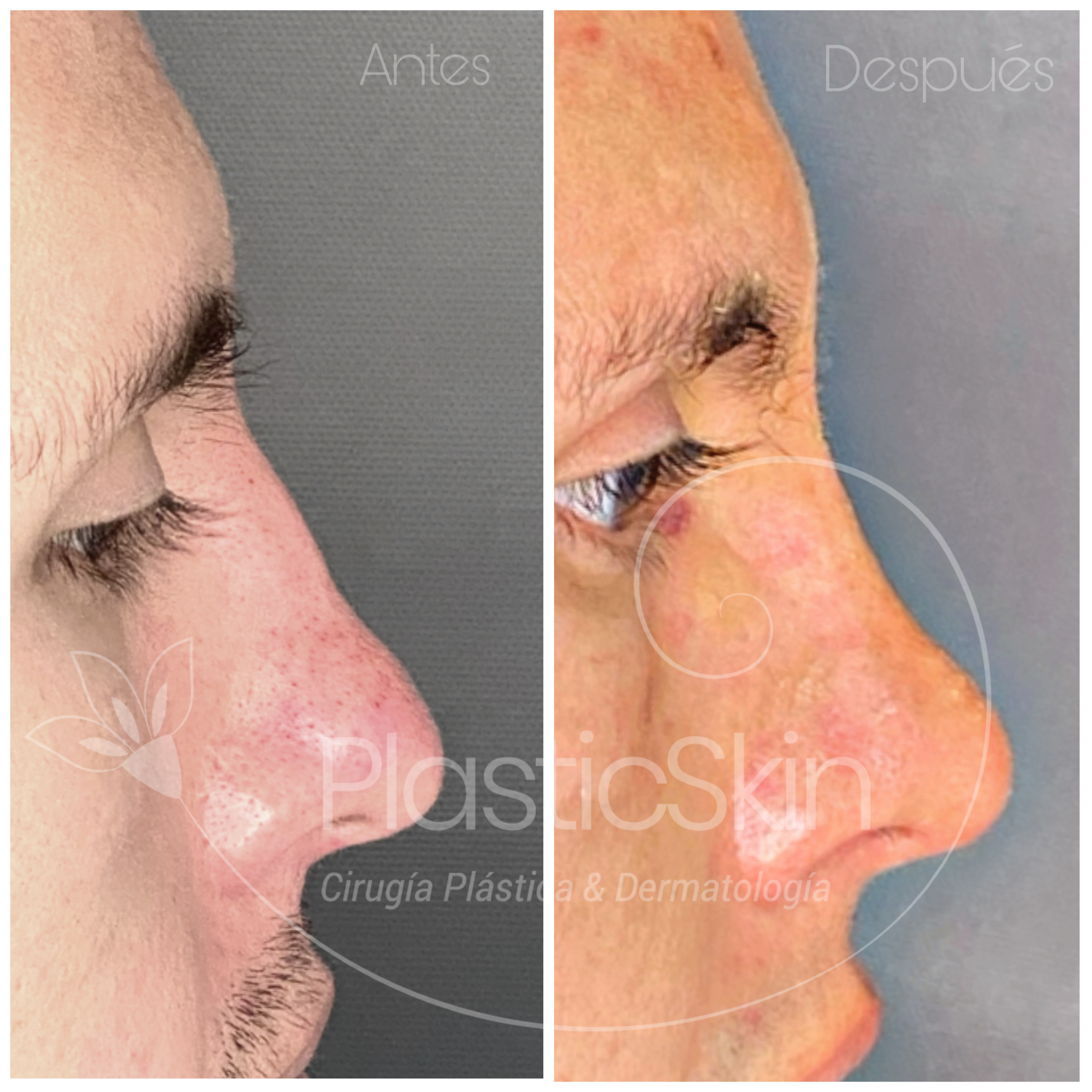 Rhinoplasty