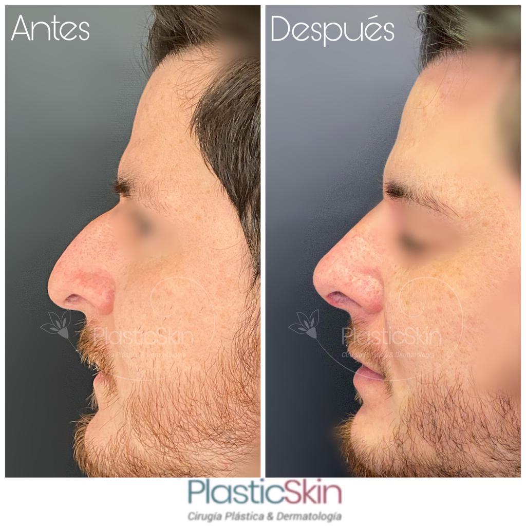 Rhinoplasty