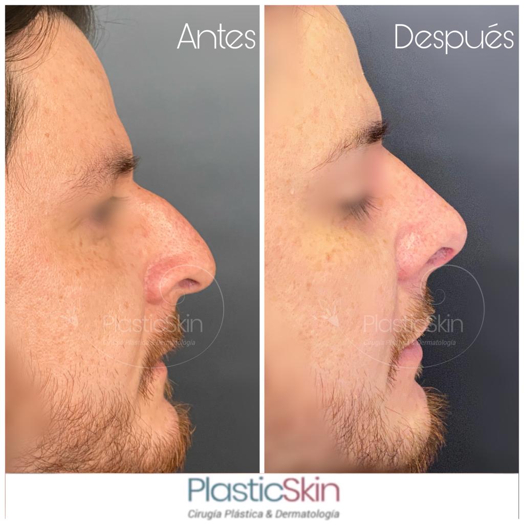 Rhinoplasty