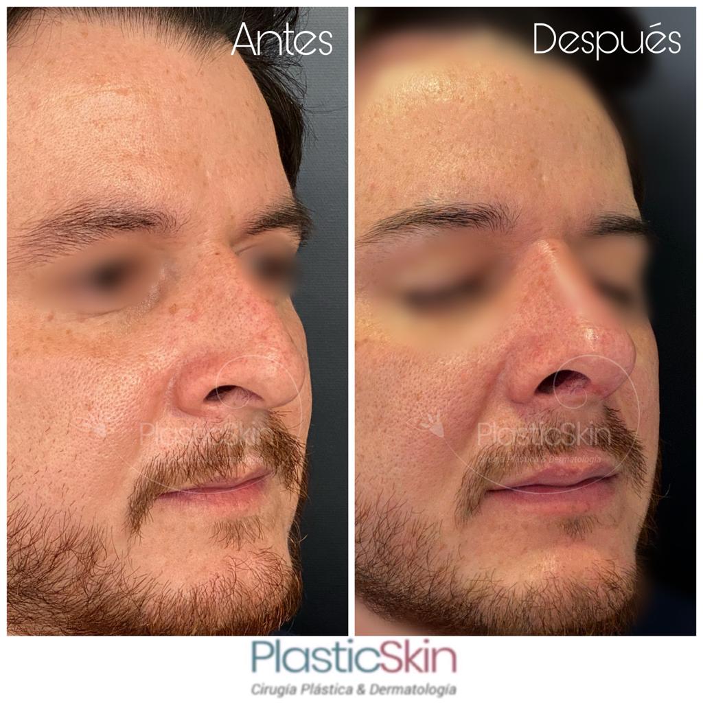 Rhinoplasty